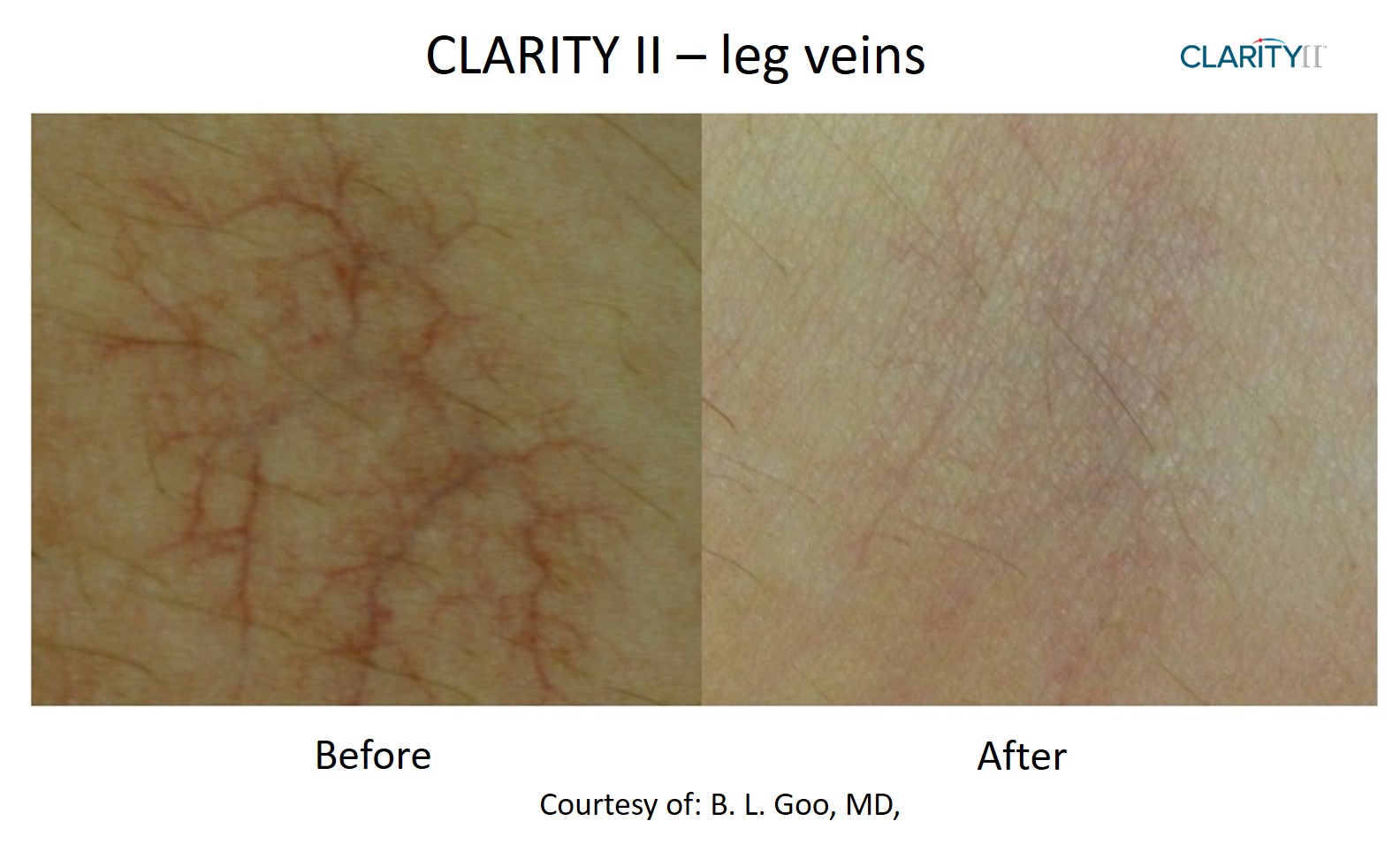 Vein Removal