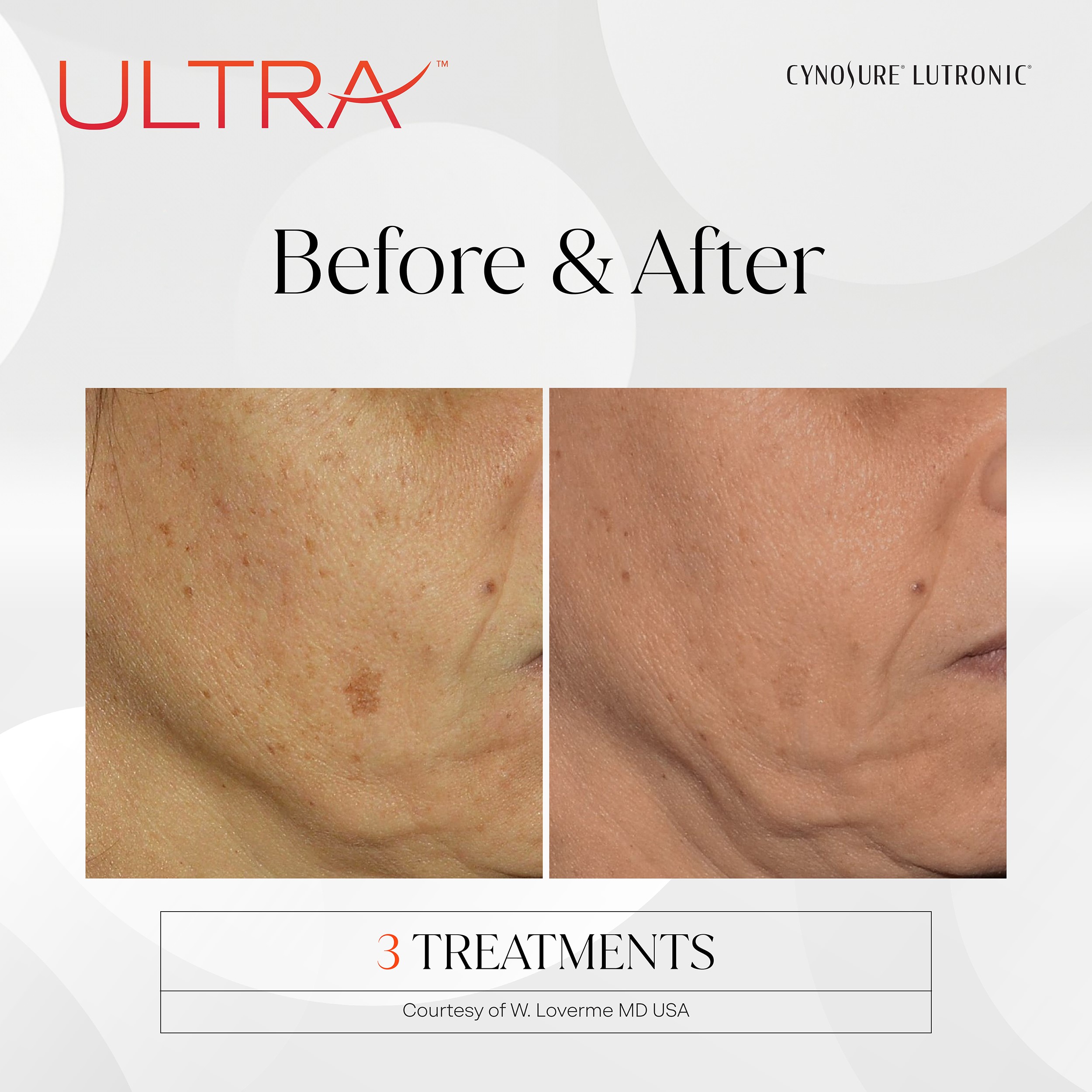 Ultra Before and After 1