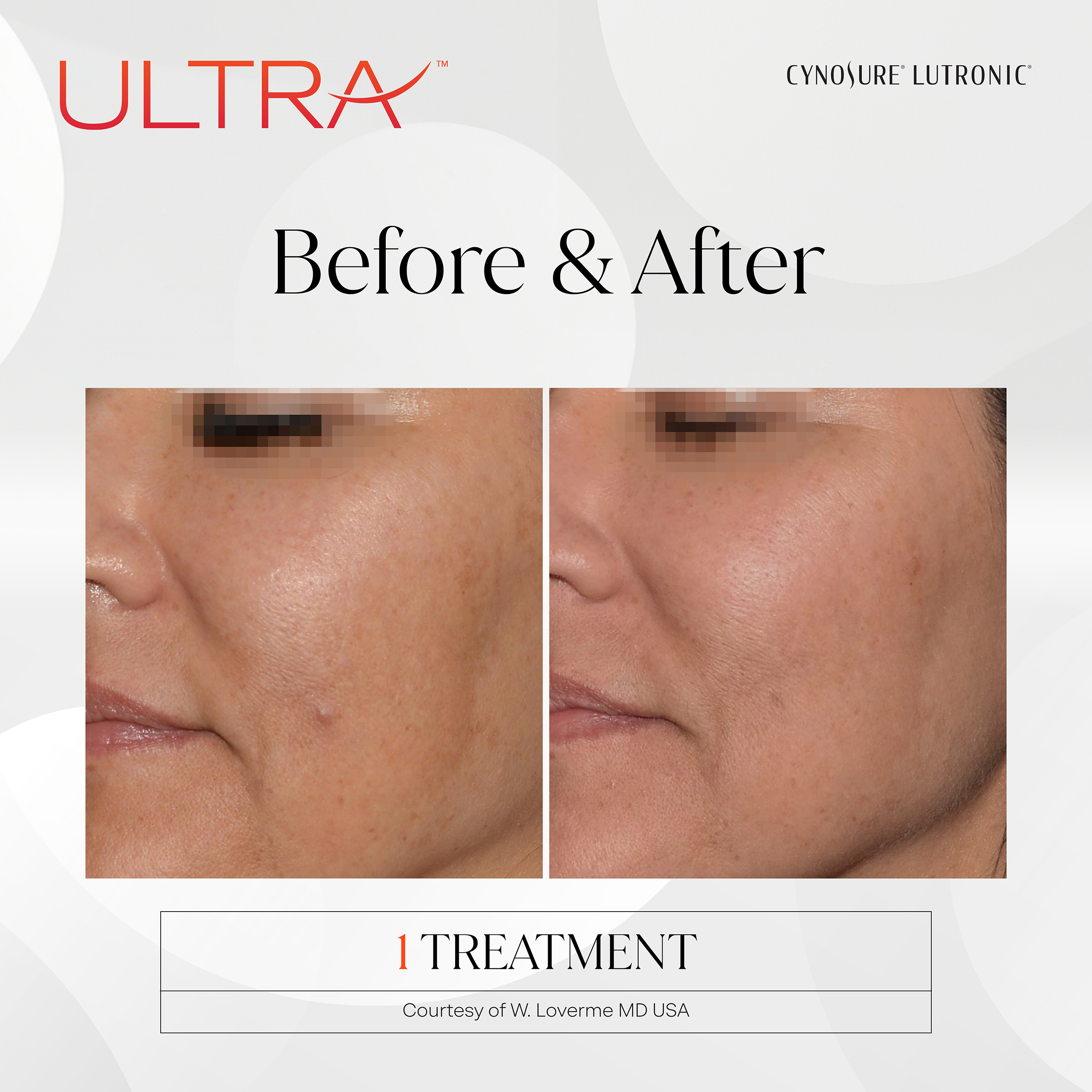 LaseMD Ultra Treatment